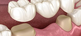 Illustration of traditional bridge being placed on teeth