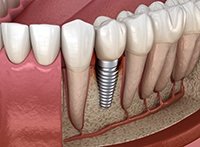 Illustration of a single dental implant