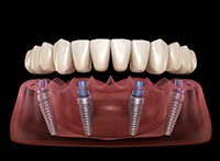 Illustration of implant denture