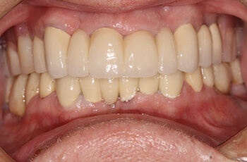 after corrected tooth decay