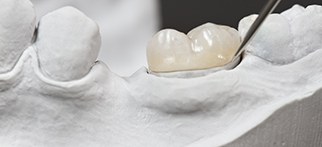 a mold of a mouth with a dental crown on top of a tooth