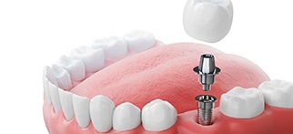 CGI illustration of a dental implant and its components in a lower arch
