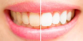 before and after of whitened smile
