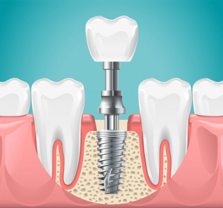 how-to-help-a-loose-dental-implant-dr-eric-marsh-dmd