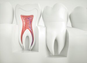 3D rendering of a cutaway image of an infected tooth next to a whole, healthy one
